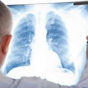 What are the Symptoms of Mesothelioma?