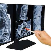 Spinal Cord Injuries Can Drastically Change Your Life