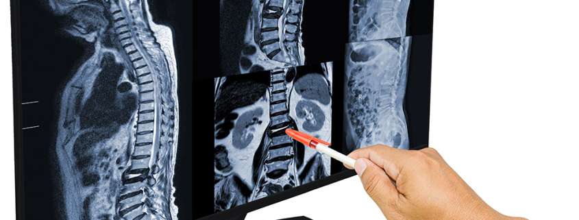 Spinal Cord Injuries Can Drastically Change Your Life