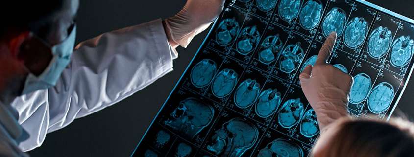 What are the Long-Term Effects of Brain Injuries?