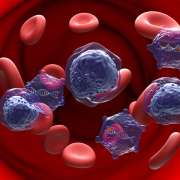Acute Myeloid Leukemia